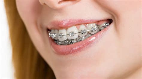 como se ponen los brackets metalicos|Cómo se colocan los Brackets Paso a Paso .